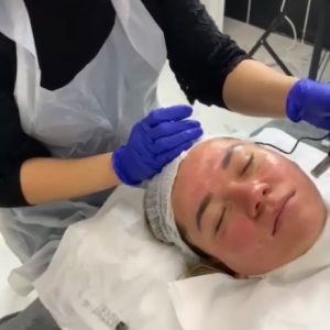 microneedling-facials-beauty-salons-in-london-clapham